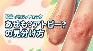 そのブツブツはあせも？それともアトピー？違いを写真でセルフチェックしよう