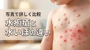 この水ぶくれはどっち？水疱瘡と水いぼの違いを写真で比較して不安を解消