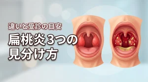 扁桃炎のウイルス性と細菌性の違いを3つのポイントで見分ける！受診の目安も紹介
